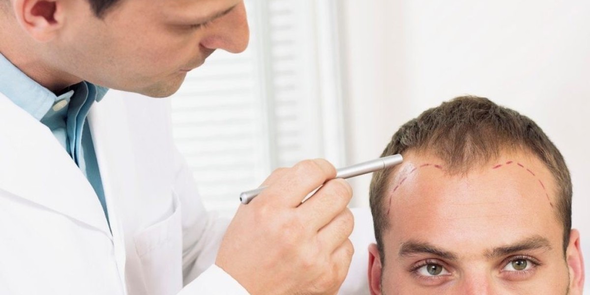Unlock Confidence Through Knowing True Hair Transplant Cost