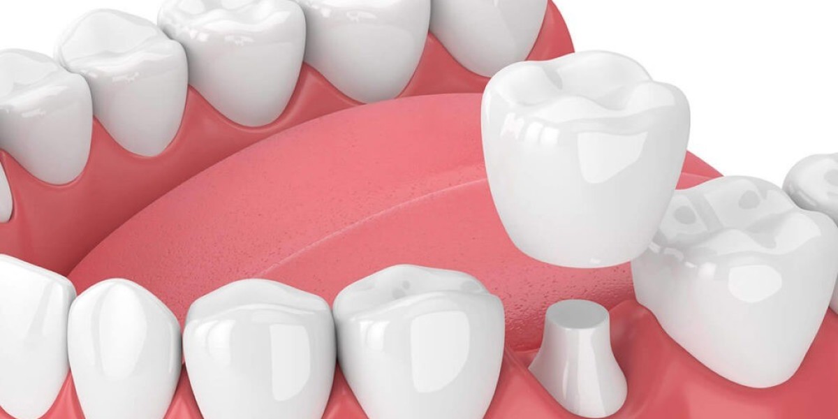 Is It Safe to Get Dental Crowns and Bridges in Dubai?