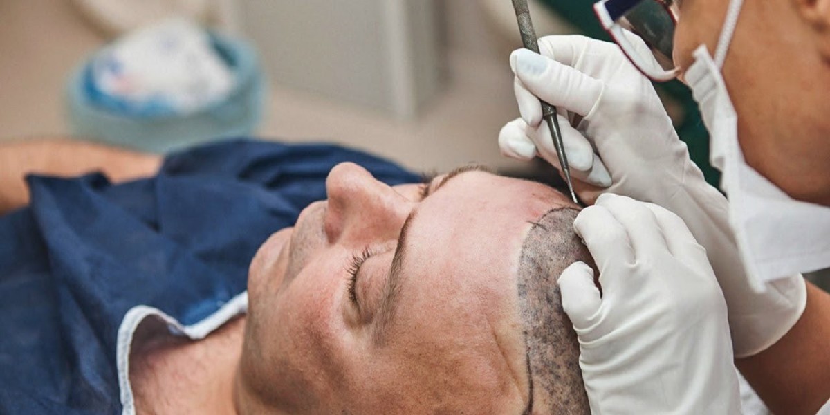 The Do’s and Don’ts After a Hair Transplant in Islamabad
