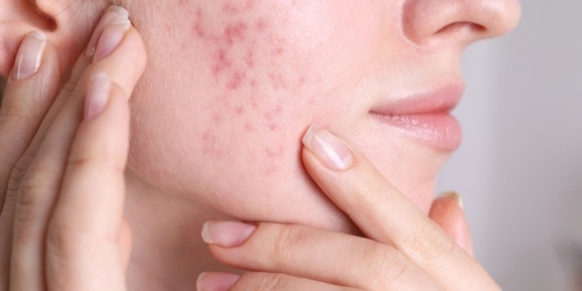 Can Acne Scar Treatments Help Lighten Skin Tone?