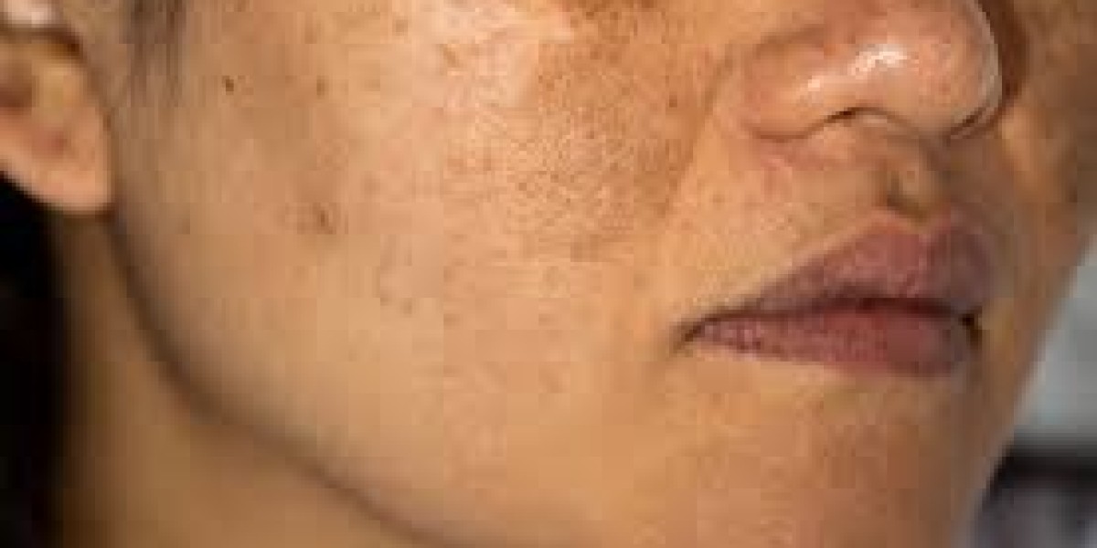 How Many Sessions Does It Usually Take to Remove Dermal Pigmentation?