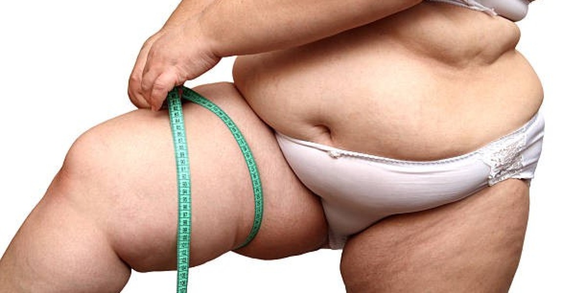 Professional Lipedema Treatment Riyadh