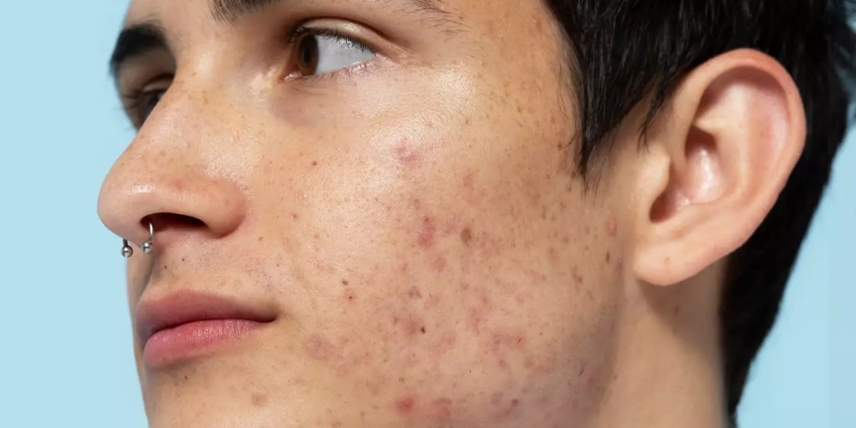 Can Pimples Treatments Effectively Diminish or Remove Acne Scars?