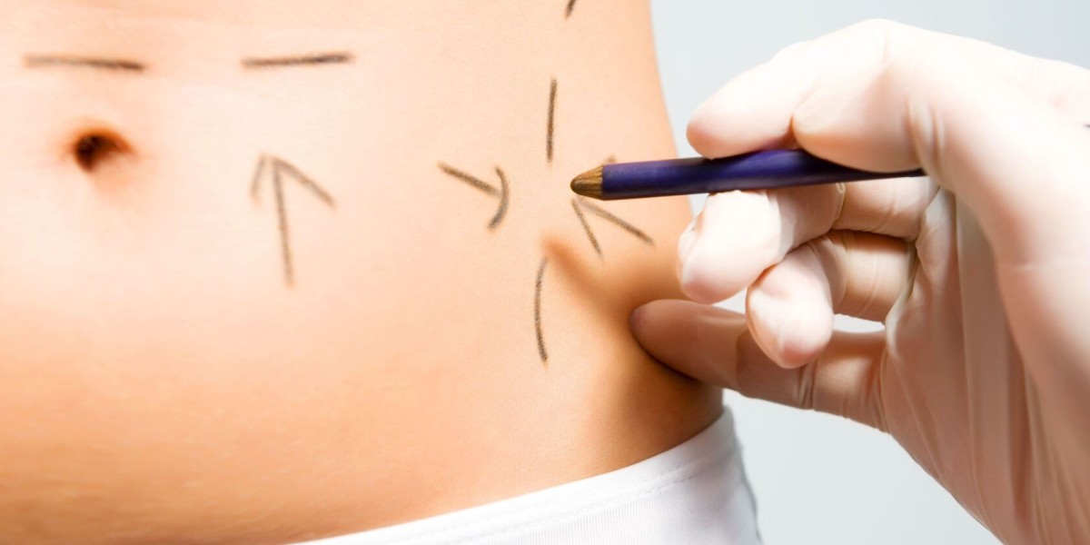 Tummy Tuck Dubai: The Key to a More Sculpted Silhouette