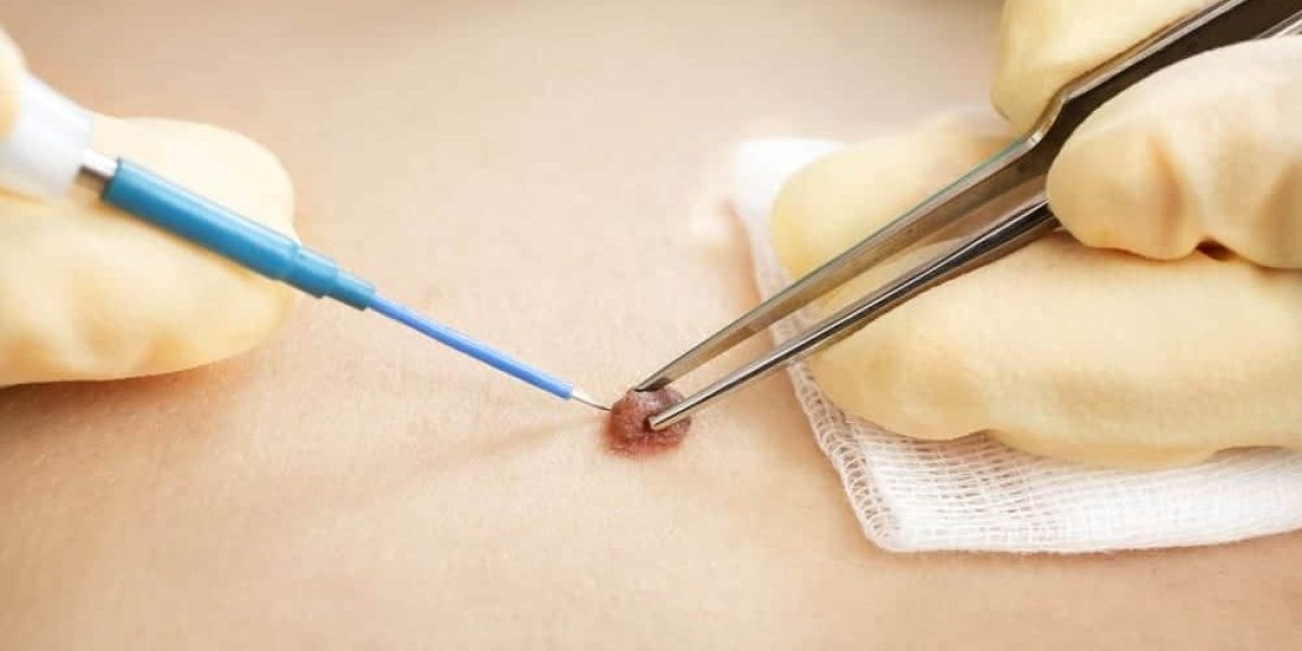 What is the Average Cost of Skin Wart Removal?