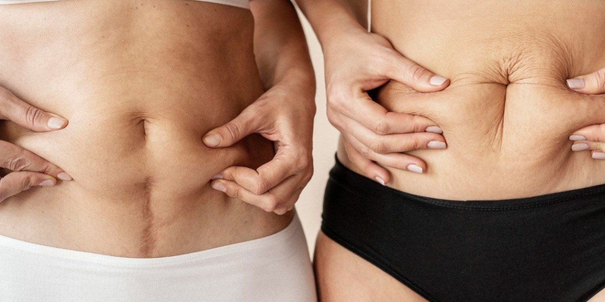 What Causes Loose Skin That Leads to a Tummy Tuck?