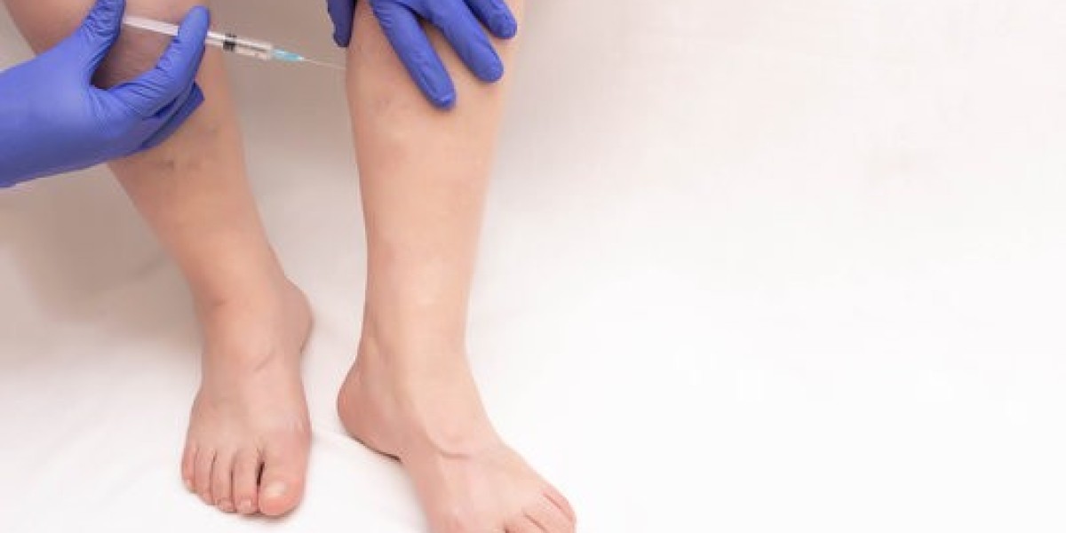 Spider Veins Treatment in Islamabad: Before and After Results
