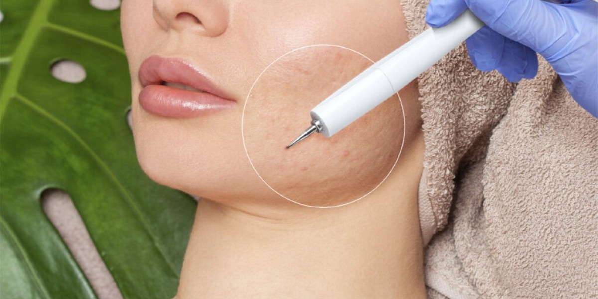 Does PRP therapy help with acne scars?