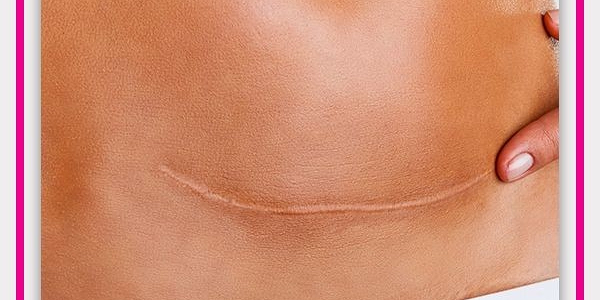 Scar Removal in Dubai for Different Skin Types: What You Should Know