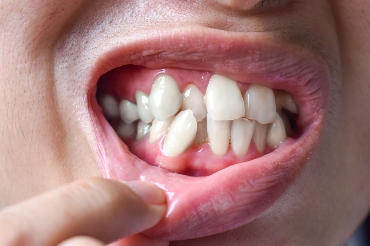 Tooth Extraction