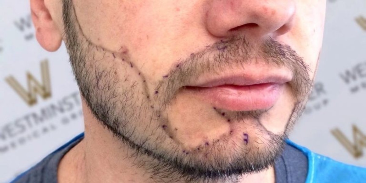 FUE Beard Transplant London: Achieve a Fuller Beard with Westminster Medical Group