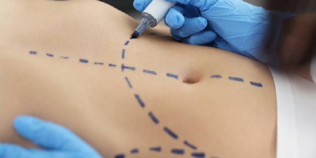Liposuction in Riyadh: Are Non-Invasive Alternatives Worth It?