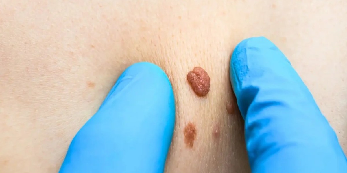 What Is the Typical Price for Skin Tag Removal?