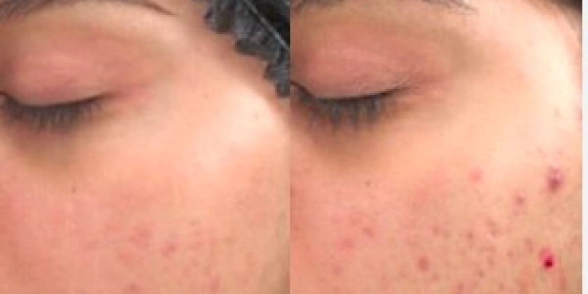 The Ultimate Checklist Before Your Microneedling Session in Islamabad