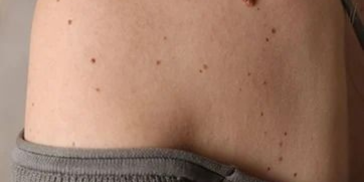 Mole Removal in Dubai for Cosmetic Reasons: Is It Worth It?