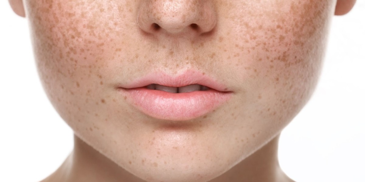 Can Microneedling Fade Dark Spots and Discoloration?