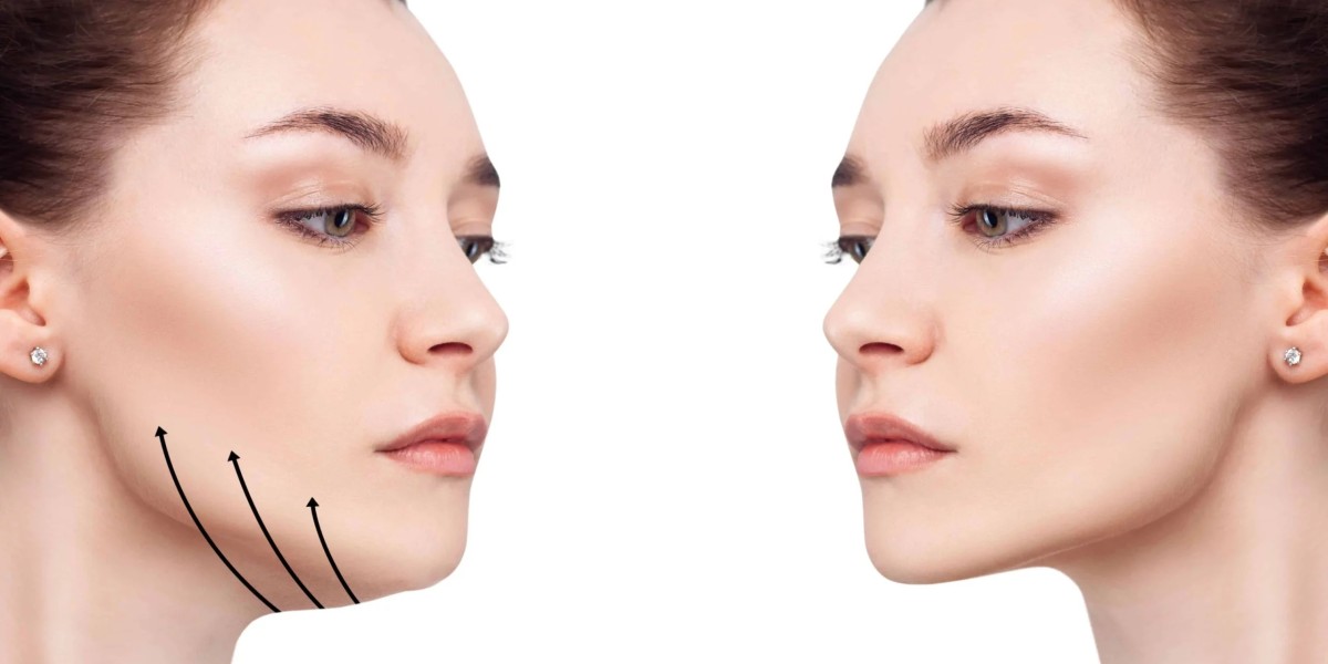 Double Chin Ultherapy Treatment in Islamabad
