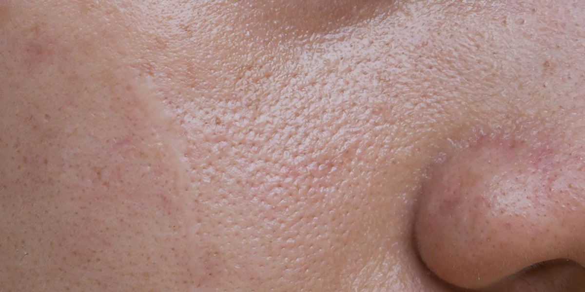 How Well Can Erbium Peel Minimize Enlarged or Noticeable Pores?