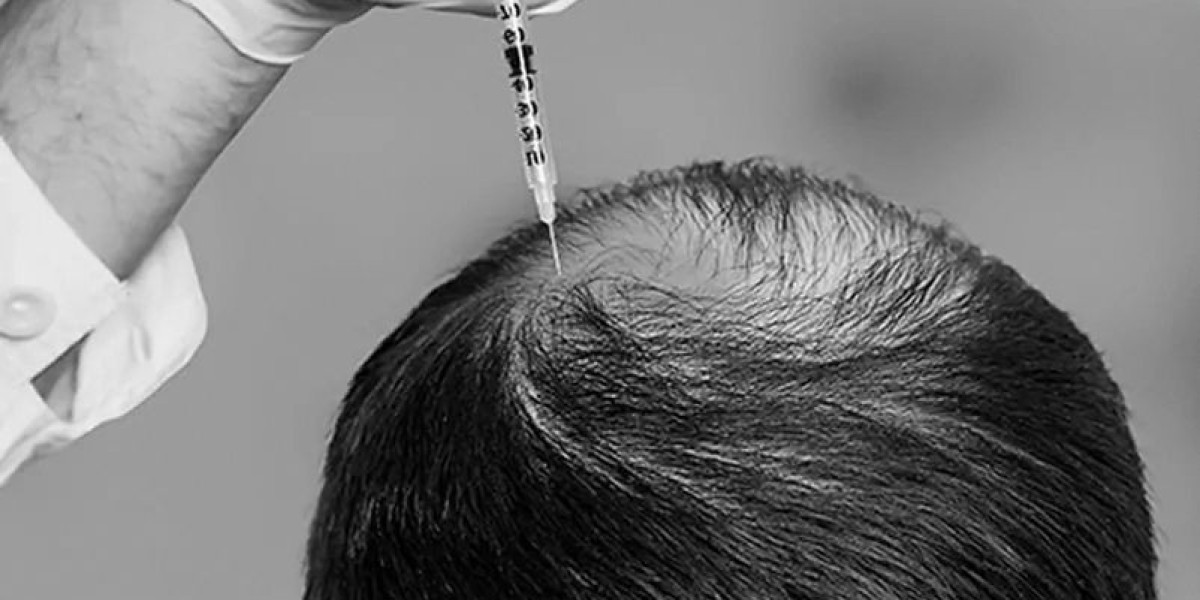 Exosomes Hair Therapy in Dubai: The Cutting-Edge Solution for Hair Loss