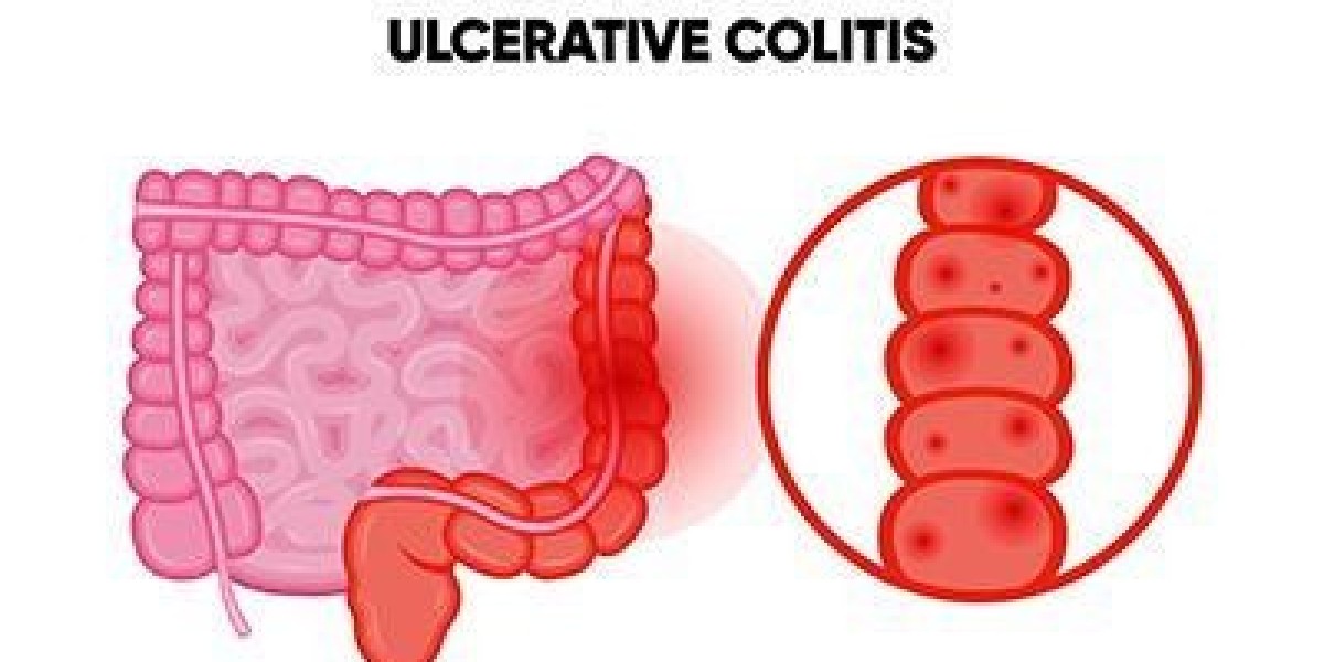 Experienced Ulcerative Colitis Doctor Ahmedabad – Specialized Digestive Care at SN Gastro by Dr. Sushil Narang