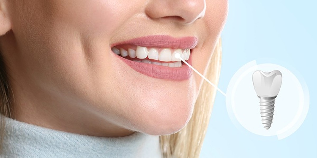 Dental Implants for Seniors: What You Need to Know