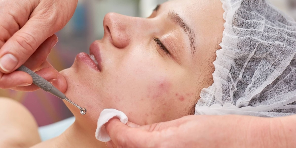 Quick Pimples Treatment in Islamabad