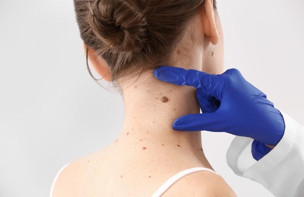 Skin Tag Removal in Dubai