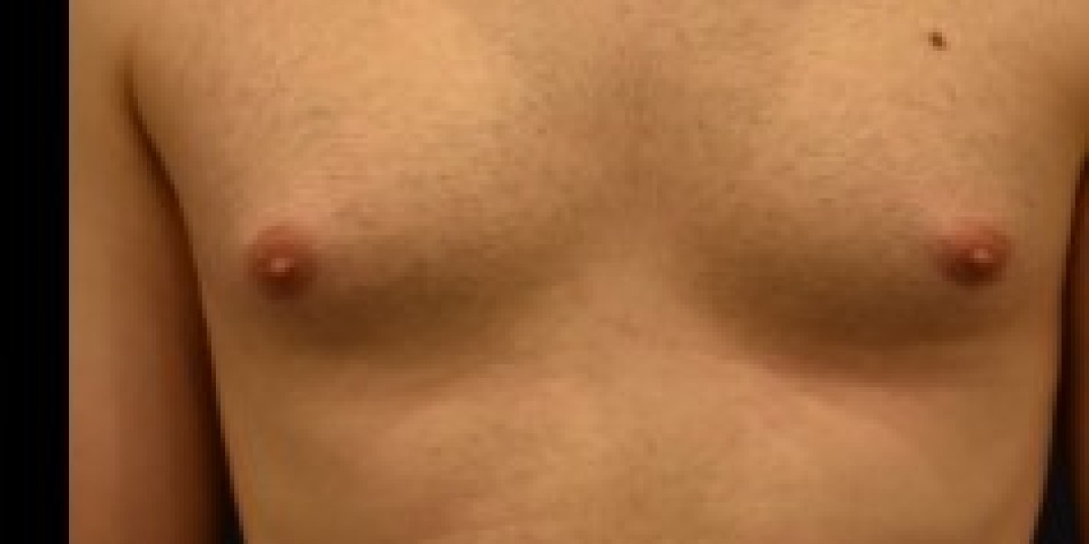 How to Reduce Gynecomastia Naturally with Proven Lifestyle Changes