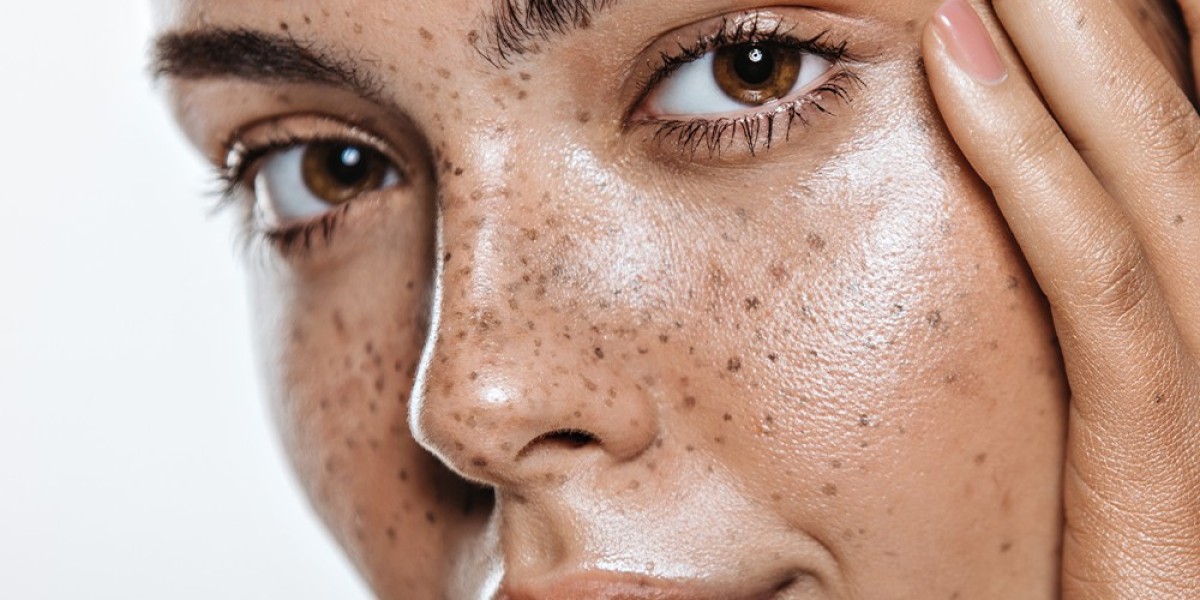 Can Laser Therapy Effectively Fade Freckles and Blemishes?