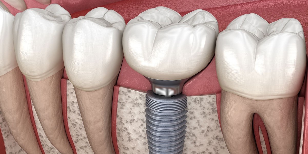 Unlock Radiant Teeth Daily Using Single Tooth Implant Cost Tips
