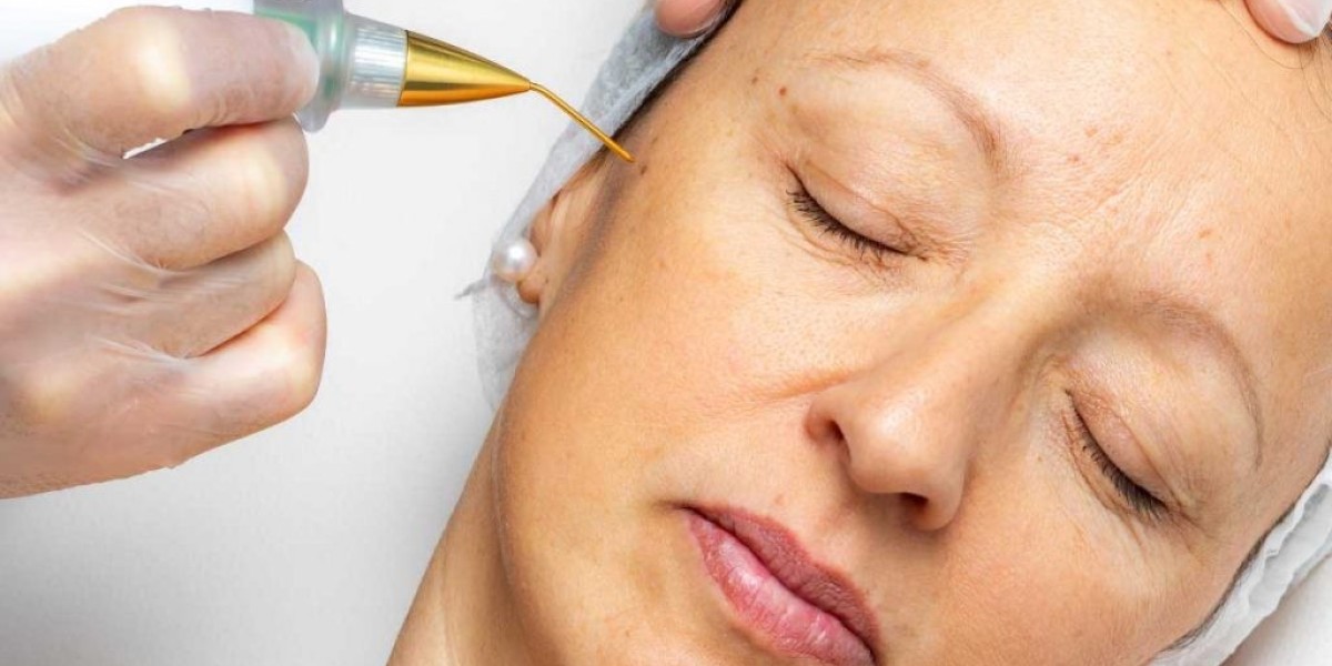 Is Plasma Pen Treatment useful for crow’s feet lines?