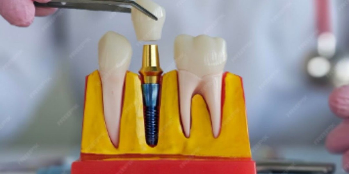 The Crucial Role of Bone Density in Dental Implant Success