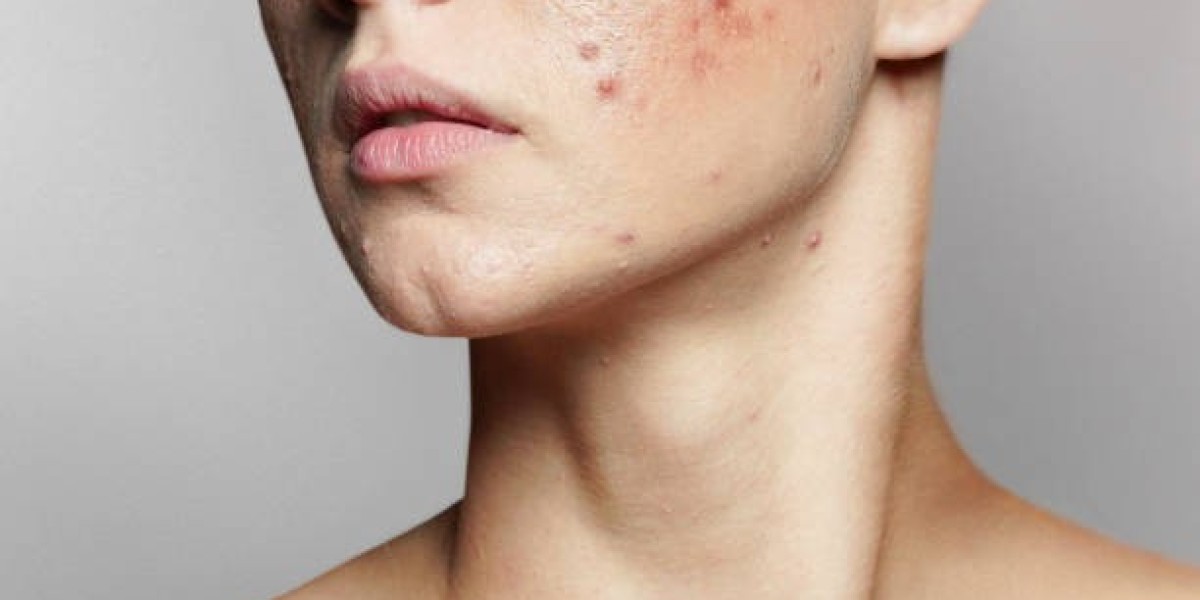 Pimples Treatment to Prevent Scars and Marks
