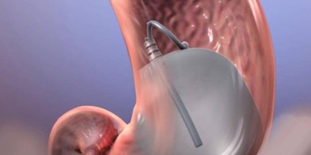 What Is the Cost of a Gastric Balloon Procedure?