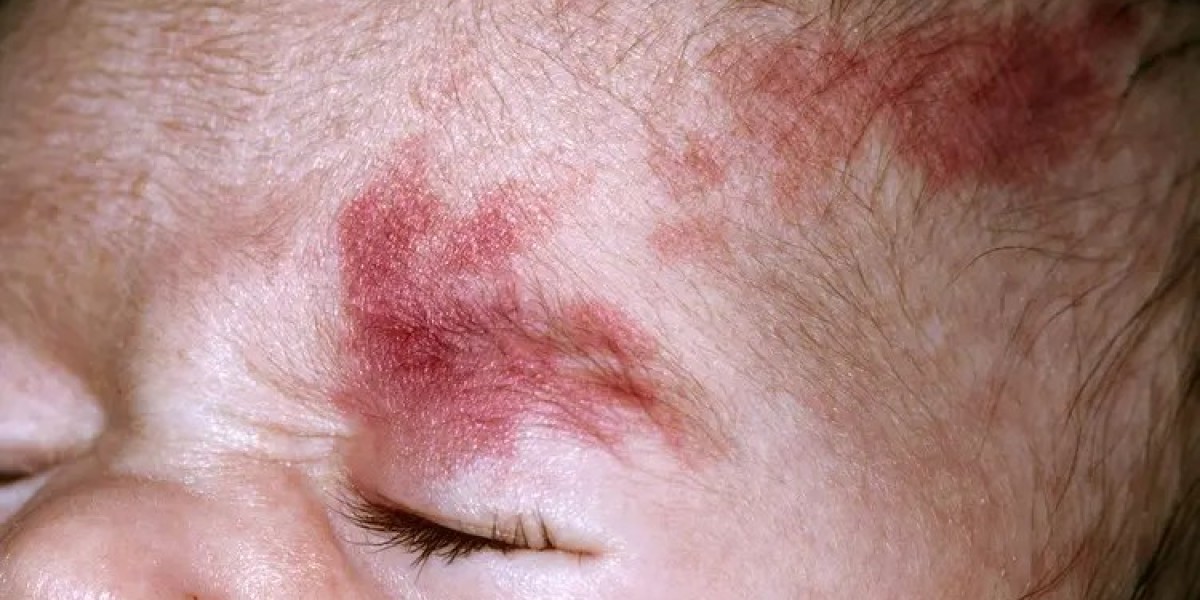 Can Children Safely Receive Port Wine Stain Treatment?