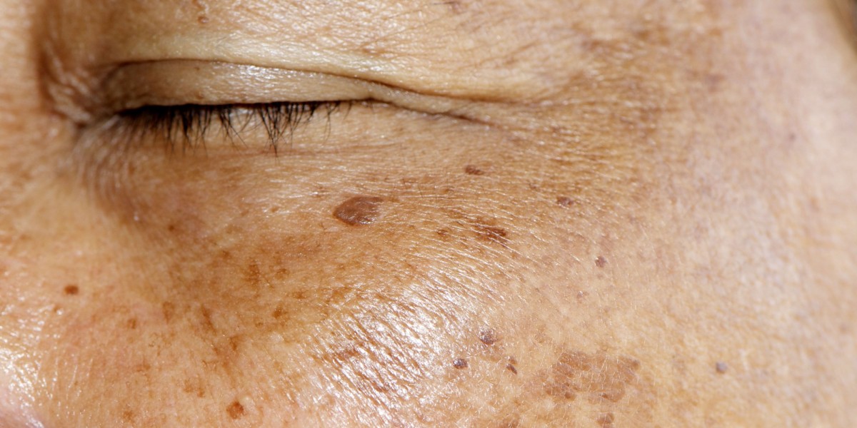 Can Laser Remove Both Freckles and Blemishes?