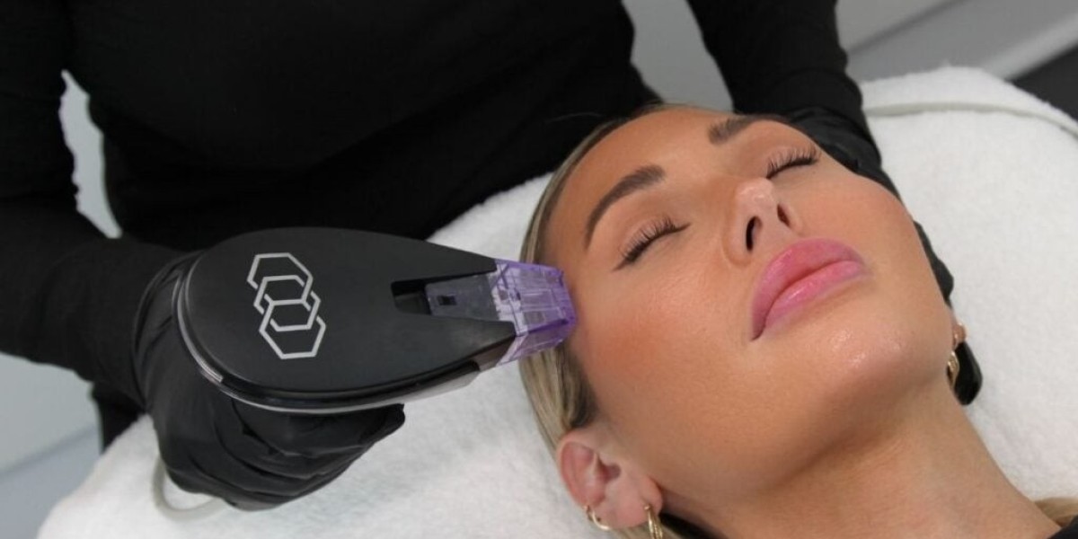 Morpheus8 for Stretch Mark Reduction: How It Works