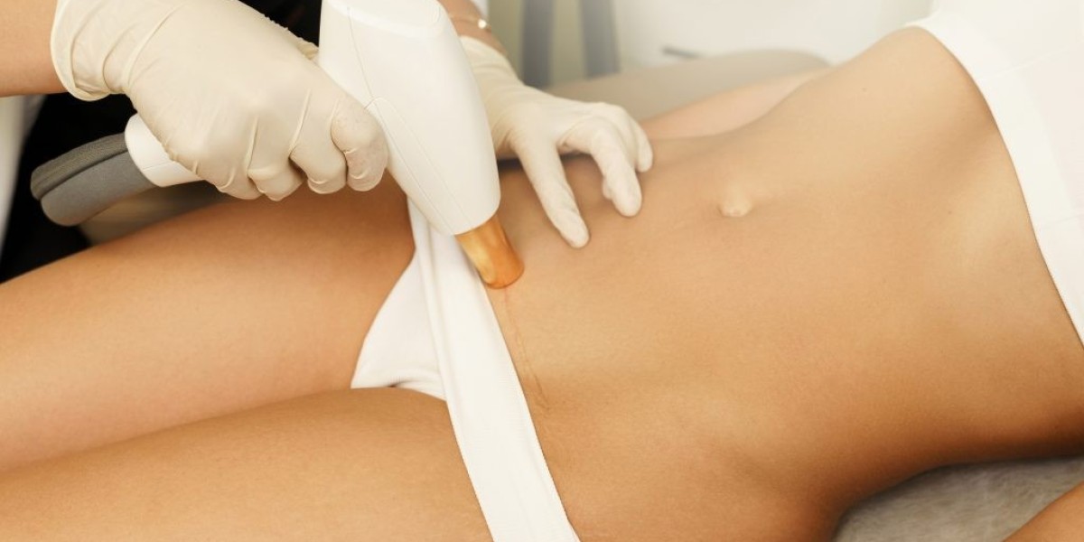 What’s Included in a Laser Hair Removal Cost Package?