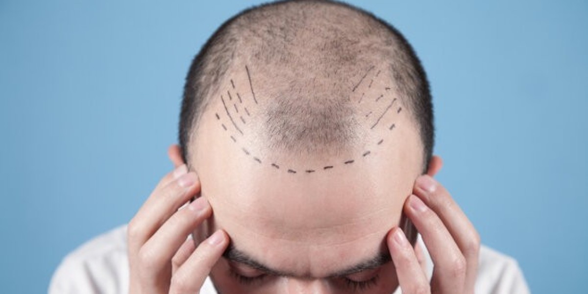 FUT Hair Transplant steady growth plan?