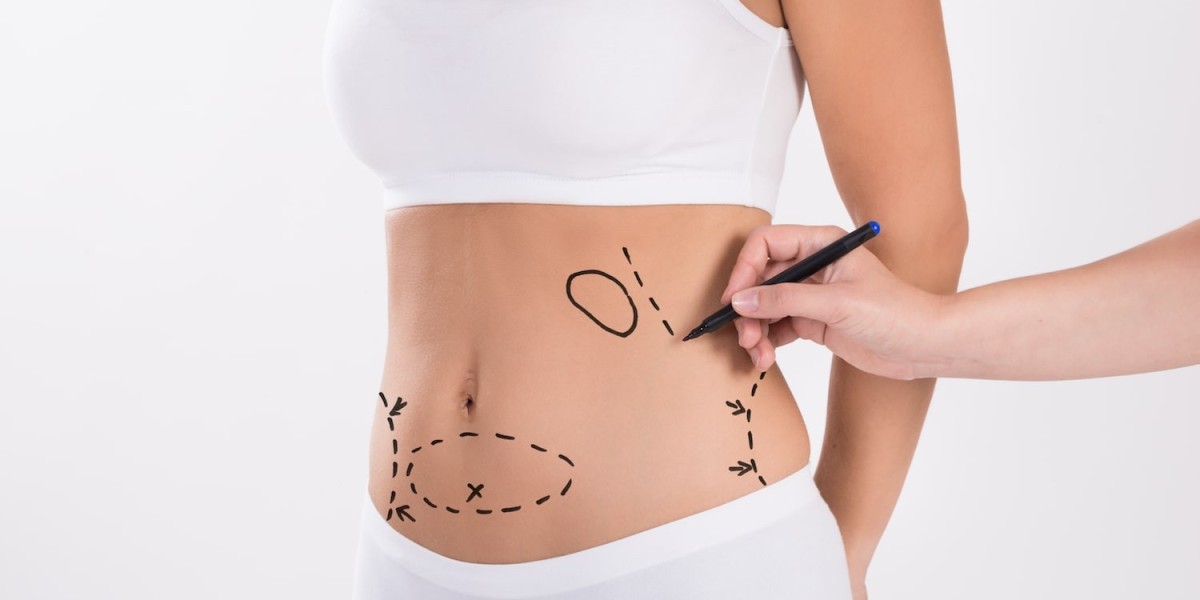 Does Liposuction Help with Cellulite Reduction?