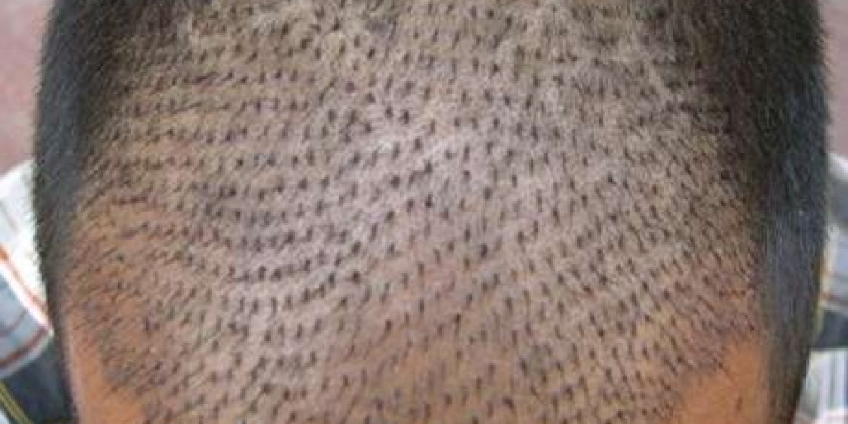 Body Hair Transplant enhance your facial appearance?