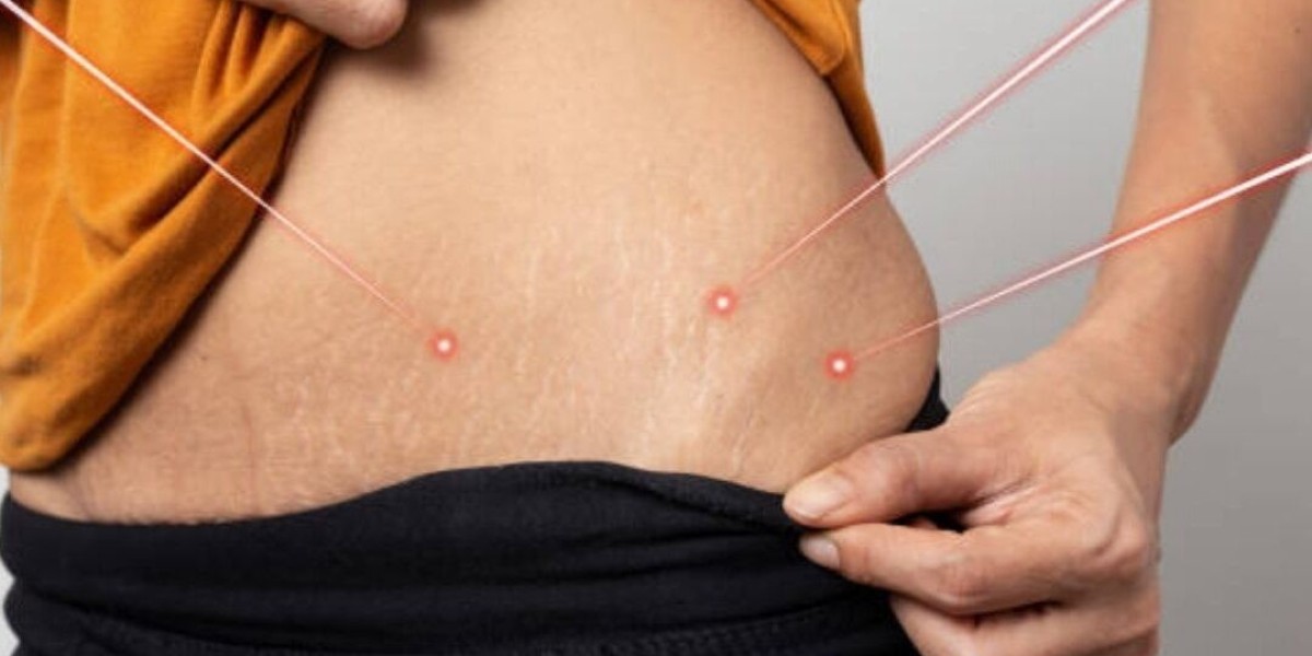 Can Laser Therapy Help Reduce the Appearance of Stretch Marks?