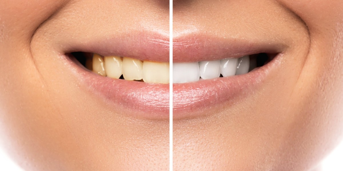 Teeth Whitening in Dubai to Help You Reveal a More Youthful Smile