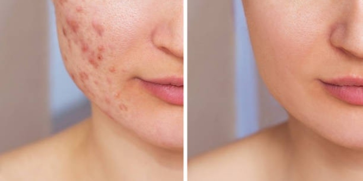 Pimples Treatment for Teenagers and Adults