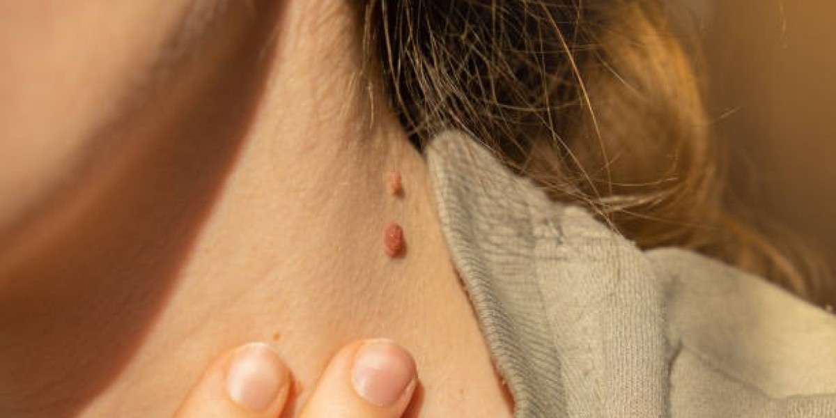 Your Guide to Mole Removal and Skin Improvement