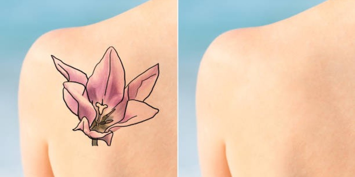 How Laser Tattoo Removal Works on Skin