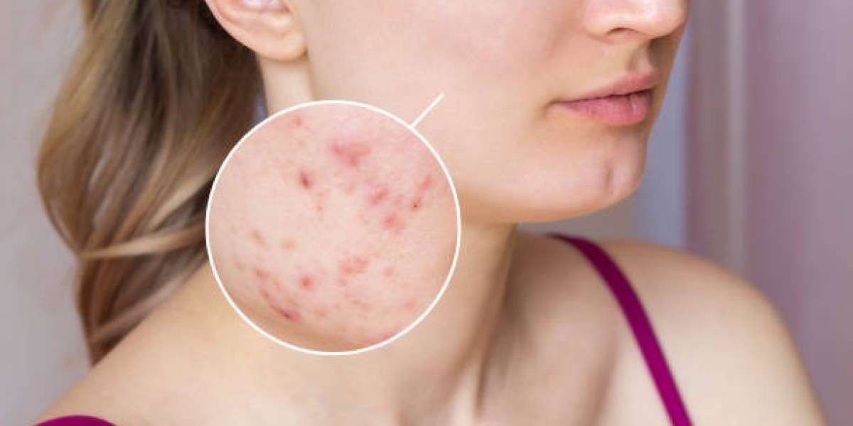 How Laser Acne Treatment Boosts Collagen and Skin Regeneration