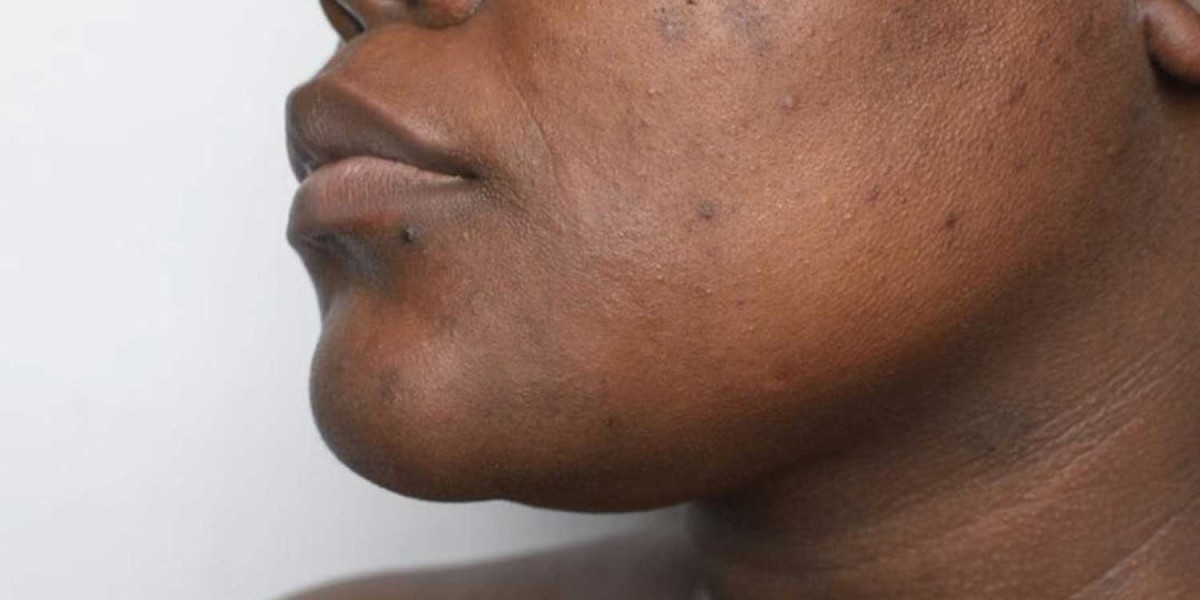 Can Skin Whitening Work on Dark Skin?