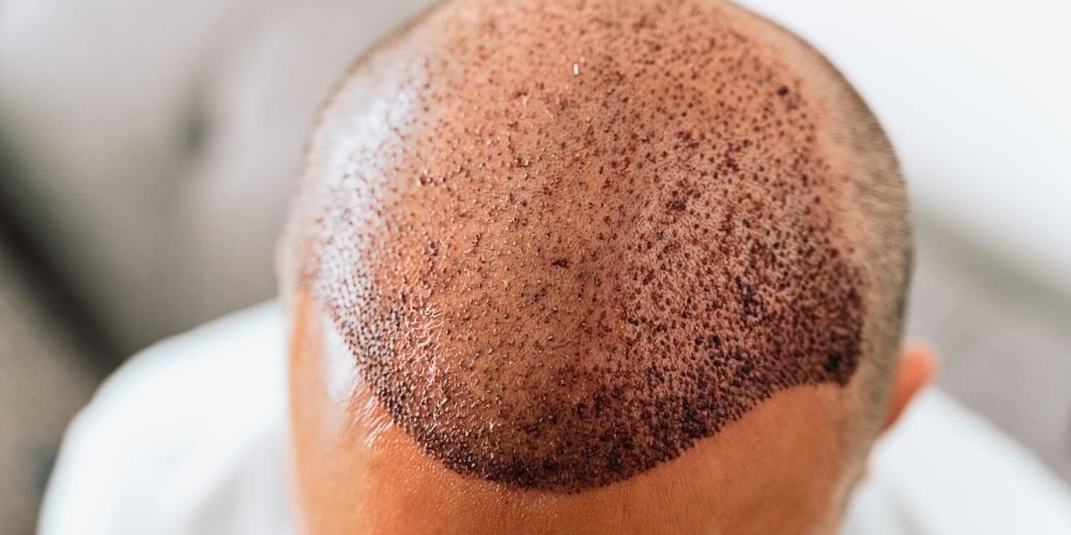 Why Natural-Looking Results Are the Key to Successful Hair Transplants