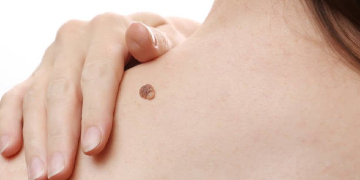Safe Mole Removal Methods for All Skin Types